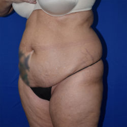 Abdominoplasty