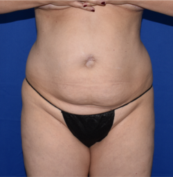 Abdominoplasty