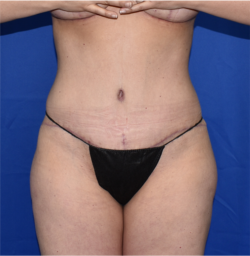 Abdominoplasty