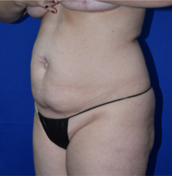 Abdominoplasty