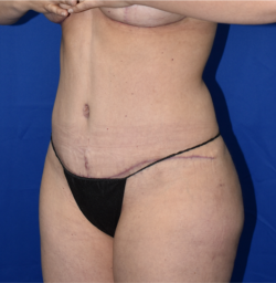 Abdominoplasty