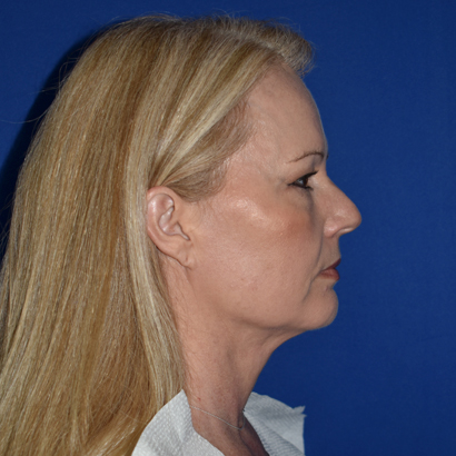 Chin Liposuction