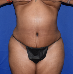 Abdominoplasty