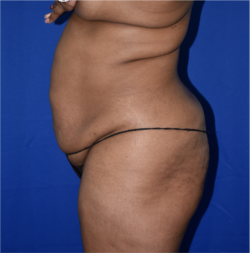 Abdominoplasty