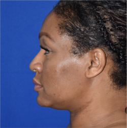 Rhinoplasty