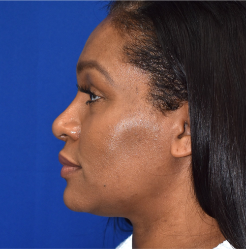 Rhinoplasty