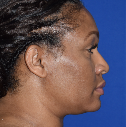 Rhinoplasty