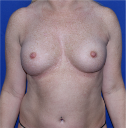 Breast Augmentation