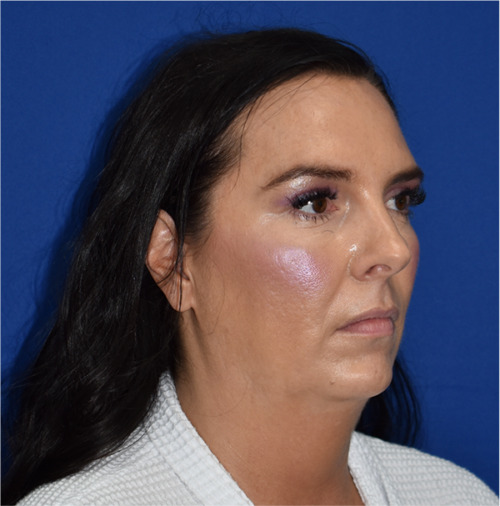 Facelift