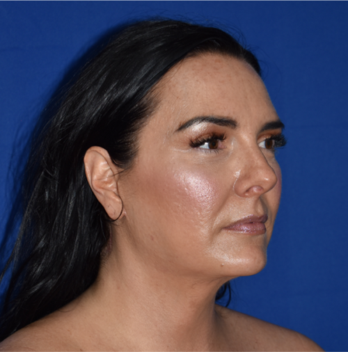 Facelift