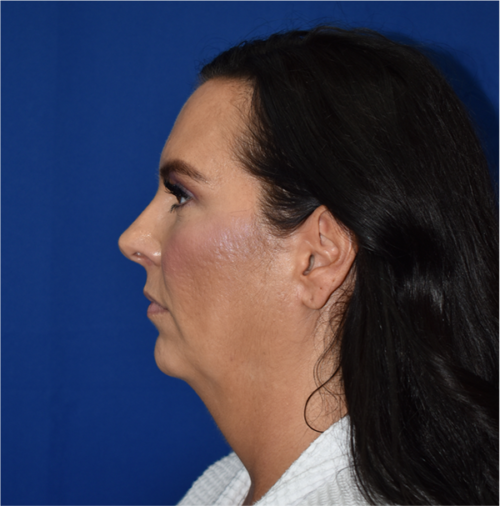 Facelift