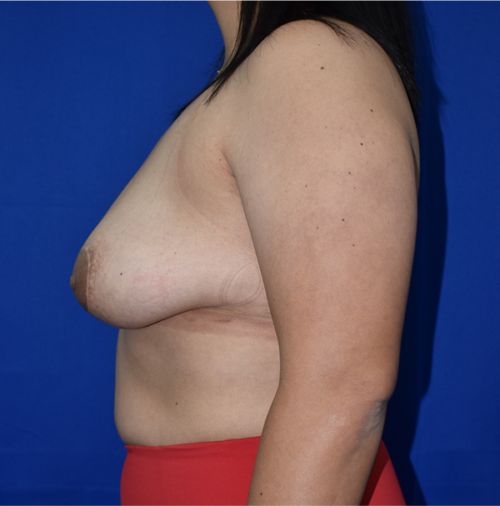 Breast Implant Removal