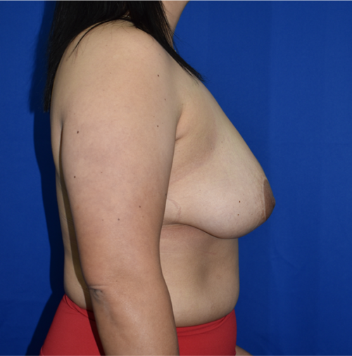 Breast Implant Removal