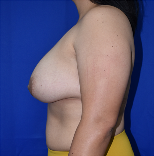 Breast Implant Removal