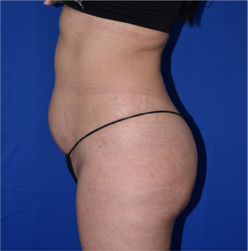 Abdominoplasty