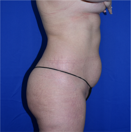 Abdominoplasty