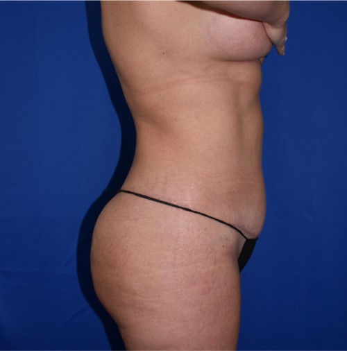 Abdominoplasty