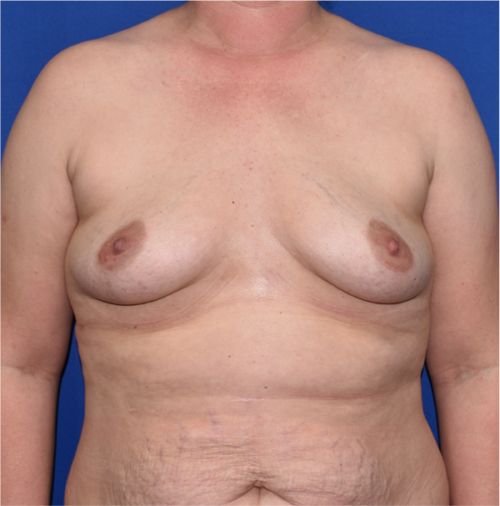 Breast Augmentation