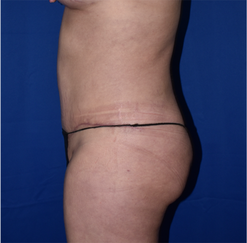 Abdominoplasty