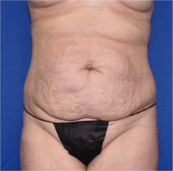 Abdominoplasty