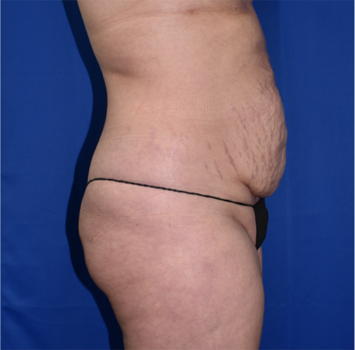 Abdominoplasty