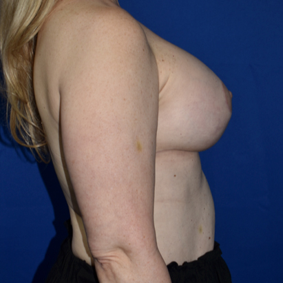 Breast Augmentation With Lift