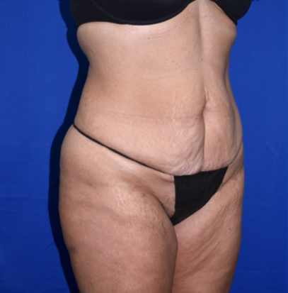 Abdominoplasty