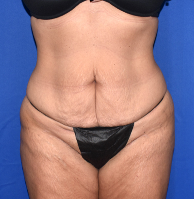 Abdominoplasty