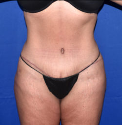 Abdominoplasty