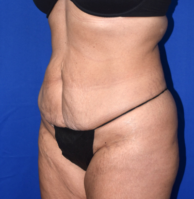 Abdominoplasty