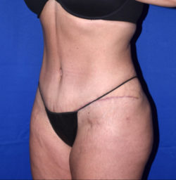 Abdominoplasty