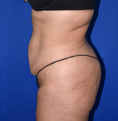 Abdominoplasty