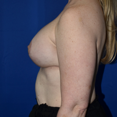 Breast Augmentation With Lift