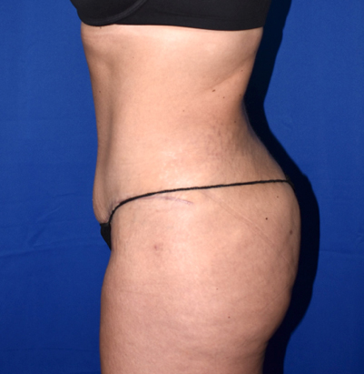 Abdominoplasty