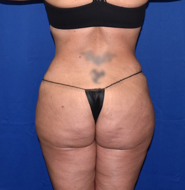 Abdominoplasty