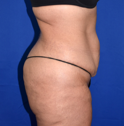 Abdominoplasty