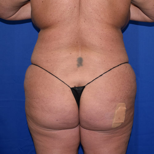 Abdominoplasty