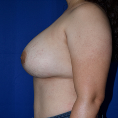 Breast Implant Revision