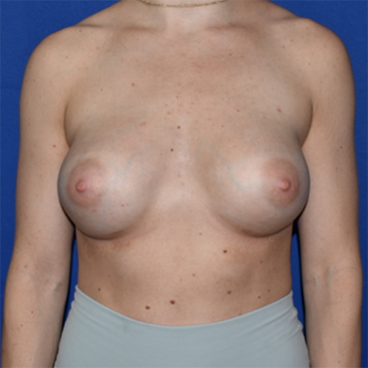 Breast Augmentation