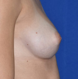 Nipple Correction