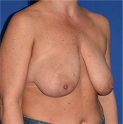 Breast Augmentation With Lift