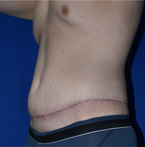 Abdominoplasty