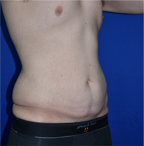 Abdominoplasty