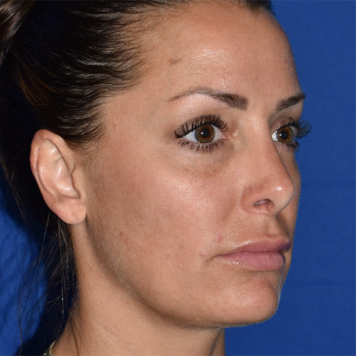 Rhinoplasty