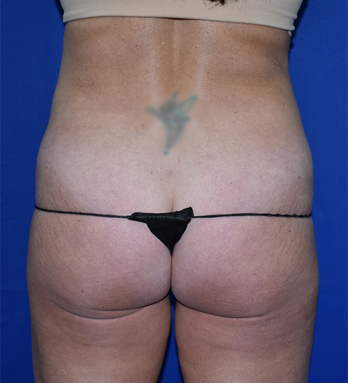 Abdominoplasty