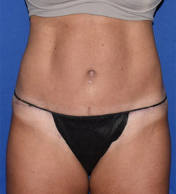 Abdominoplasty