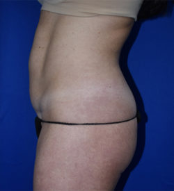 Abdominoplasty