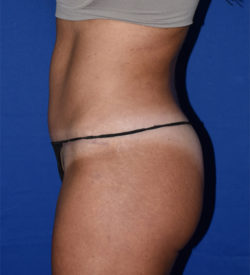 Abdominoplasty