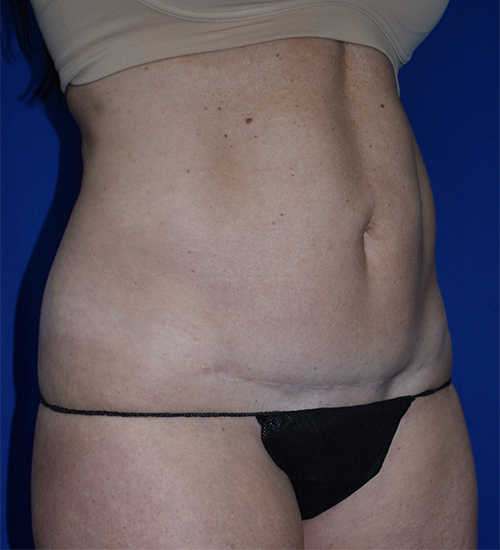 Abdominoplasty