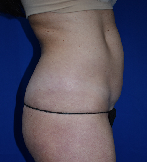 Abdominoplasty